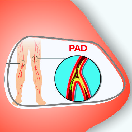 Peripheral Vascular Treatment in lucknow