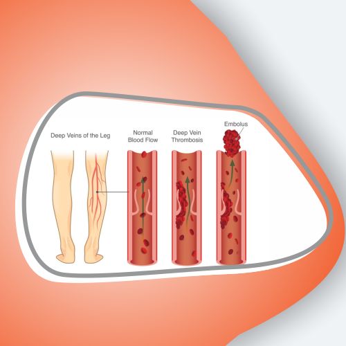 Deep Vein Thrombosis Treatment in Lucknow